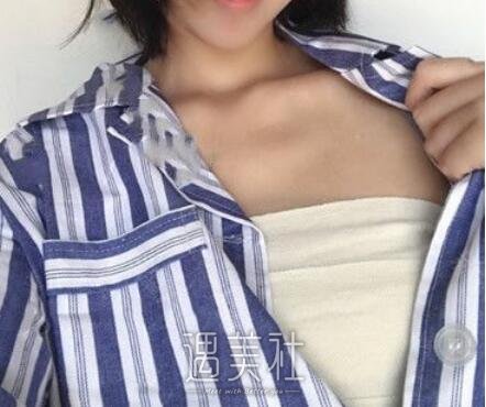 王明利,自体脂肪丰胸