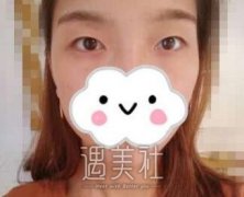 哈尔滨211医院做双眼皮怎么样?康康案例就造了 width=