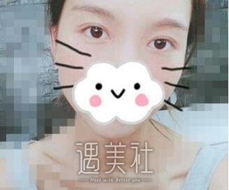 哈尔滨,211医院,双眼皮
