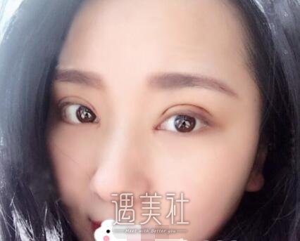 上海,九院,苏薇洁,双眼皮