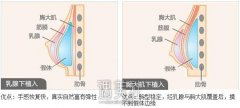 丰胸手术恢复时间是多久？禁忌人群有哪些? width=