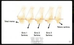 假体隆胸手术有没有风险？术后应该如何保养？ width=