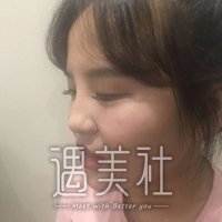 泰安中心医院整形科怎么样?吴军成双眼皮案例一览~