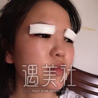 泰安中心医院整形科怎么样?吴军成双眼皮案例一览~