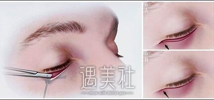 漳州,眼袋修复