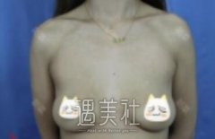 南昌甘海平丰胸案例  分享我的亲身经历 width=