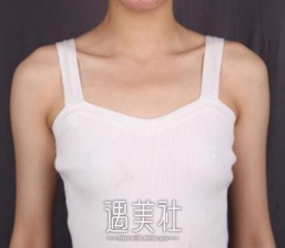 冯斌,自体脂肪丰胸