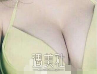 冯斌,自体脂肪丰胸