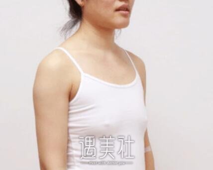 李朕,丰胸