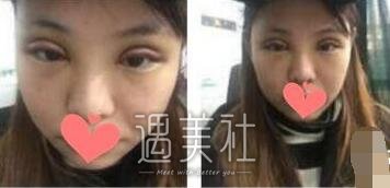杜园园,双眼皮