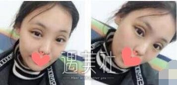 杜园园,双眼皮