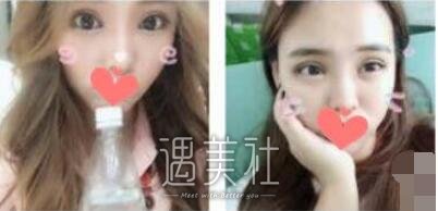 杜园园,双眼皮
