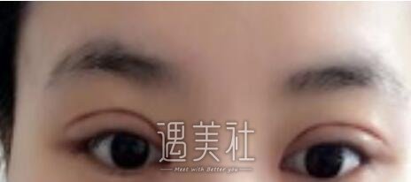 李敏,双眼皮