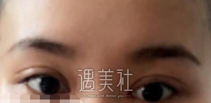 李敏,双眼皮