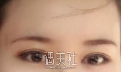 李敏,双眼皮