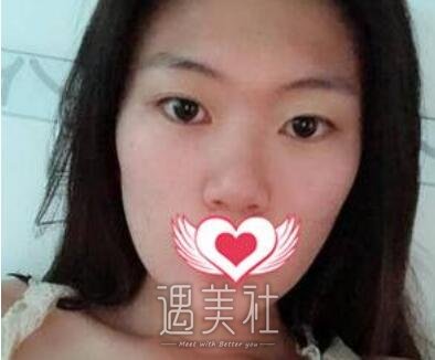 苏薇洁,双眼皮