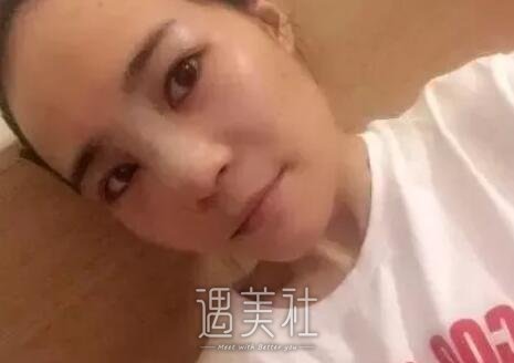 李青峰,隆鼻