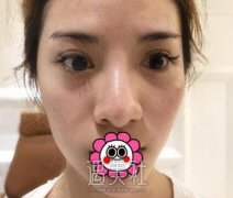 牛永敢隆鼻案例 不愧是牛鼻子 width=