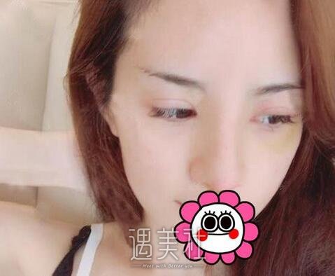 牛永敢,隆鼻