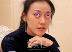 刘彦军隆鼻案例图片 与美本无缘 全靠我花钱 width=