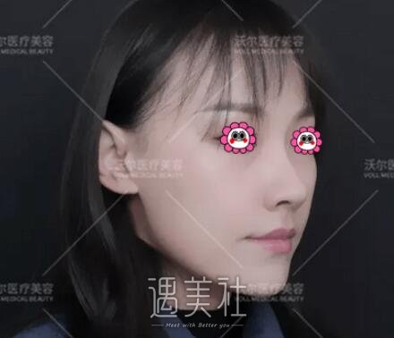 刘彦军,隆鼻