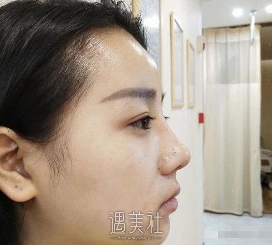于立民做鼻子好吗|于立民隆鼻案例硬核证明~