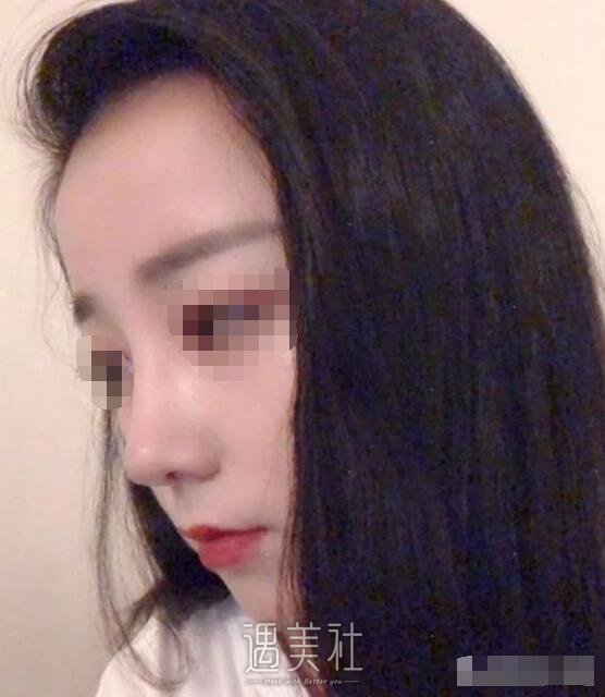 于立民做鼻子好吗|于立民隆鼻案例硬核证明~