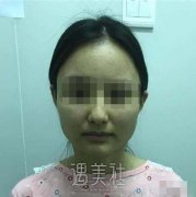 上海首尔丽格做下颌角怎么样?在线案例一览~ width=