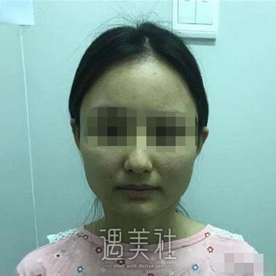 上海首尔丽格做下颌角怎么样?在线案例一览~