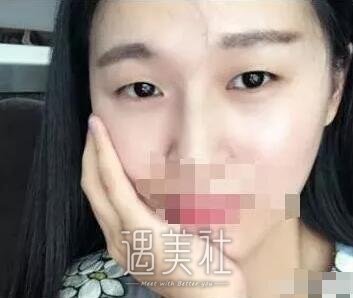 泰安中心医院整形科做双眼皮吗?果怎么样?