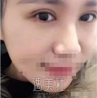 泰安中心医院整形科做双眼皮吗?果怎么样?