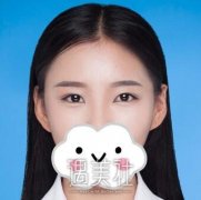 张卓男双眼皮案例：62天纪实转变记录~ width=