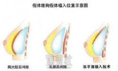 假体隆胸的果好不好？手术的危险表现在哪里？ width=
