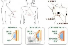假体隆胸后要怎么护理才能够促进恢复？适应人群是哪些？ width=