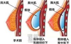 南京假体隆胸术怎么收费？调节乳头肥大的价格是多少？ width=