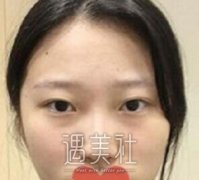 成都华美宋晓东隆鼻案例：鼻子立体了，美貌自然有~ width=