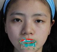 上海九院谢峰双眼皮案例：从眯眯眼到魅力电眼精的逆袭~ width=