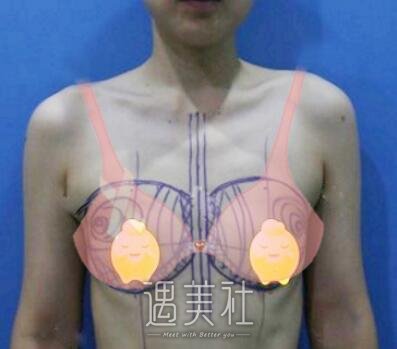 韦元强,丰胸