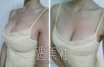 朱欣欣,丰胸