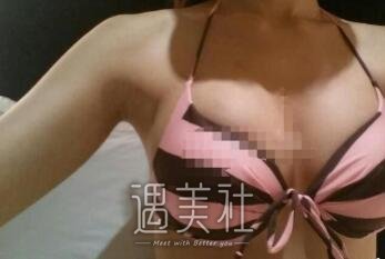朱欣欣,丰胸