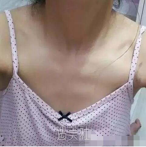 上海,九院,王涛,假体丰胸