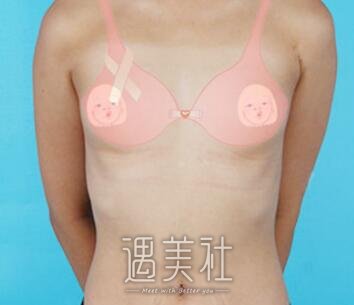 美莱,王勇,丰胸