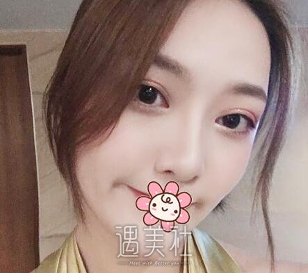 王先成,隆鼻