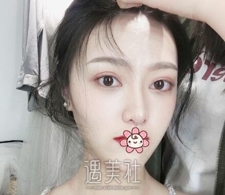 王先成,隆鼻