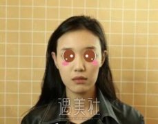 北京王军隆鼻案例 俺也有侧颜杀辣 width=