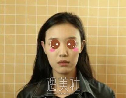 北京,王军,隆鼻