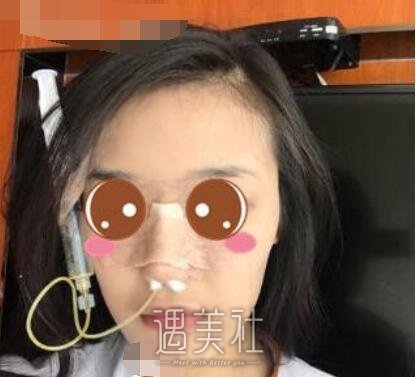 北京,王军,隆鼻