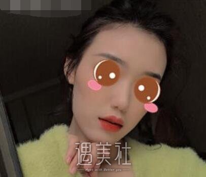 北京,王军,隆鼻