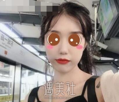 北京,王军,隆鼻