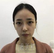 金孝宪隆鼻案例 来品品这果叭！ width=